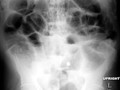 Generalized Ileus. All loops of bowel, large and small, are dilated. Generalized ileus occurs in post-operative patients or those with electrolyte imbalance. Gas will be present in large bowel and rectosigmoid.