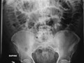 Small Bowel Obstruction. Multiple dilated loops of small bowel with little or no gas in the large bowel or rectosigmoid. Usually caused by adhesions. Note valvulae stretch from wall to wall.