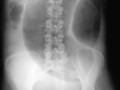 Large Bowel Obstruction-Sigmoid Volvulus. Markedly dilated loop of sigmoid stretches from pelvis into the upper abdomen. Largest loops of dilated bowel occur with volvulus.