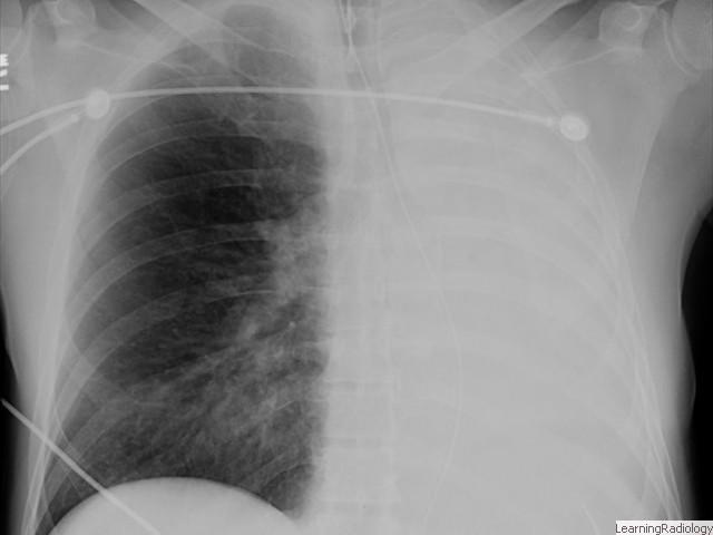 Atelectasis Left Lung- Increased density of the affected lung with shift of the fissures or the mediastinal structures towards the atelectasis. Overaeration of the opposite lung. 