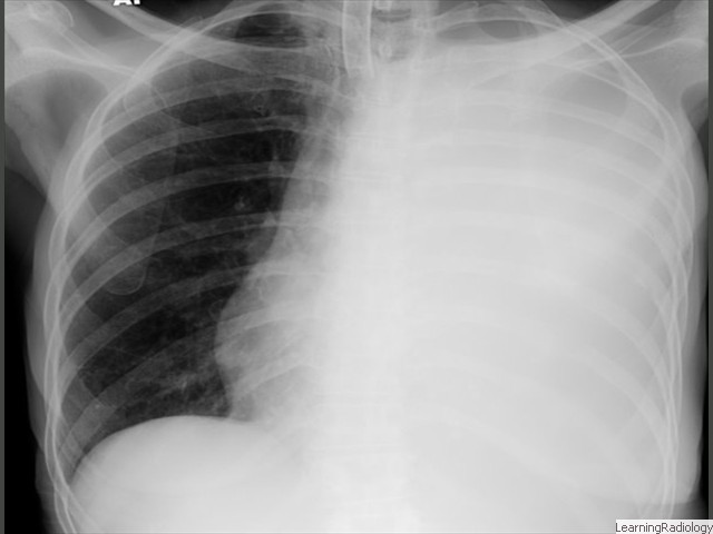 Effusion and Atelectasis-opacified hemithorax with no shift of heart or mediastinal structures. Implies large effusion with underlying obstructive atelectasis, a combination ominous for bronchogenic carcinoma with metastases. 