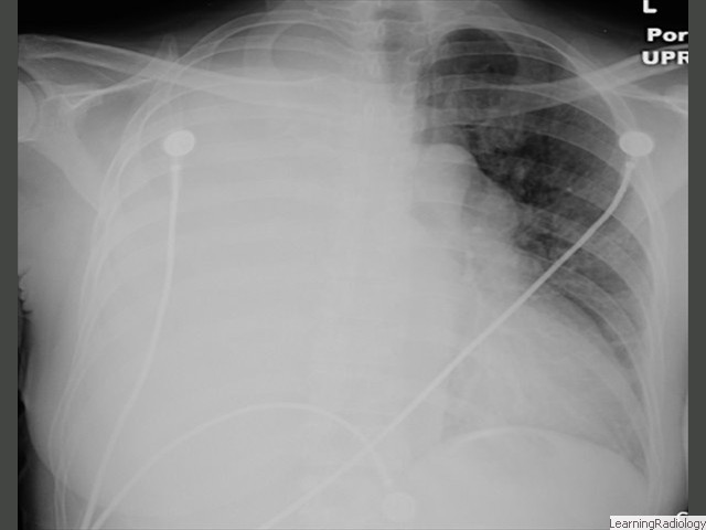 Large Right Pleural Effusion-Shift of heart and mediastinal structures away from side of opacified hemithorax. Large effusion occupies more space. 