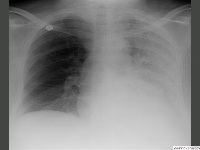 Pneumonia-No shift of heart or trachea. Less homogeneously opaque than effusion or atelectasis. Air bronchograms possible. <br/>