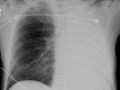 Atelectasis Left Lung- Increased density of the affected lung with shift of the fissures or the mediastinal structures towards the atelectasis. Overaeration of the opposite lung. 