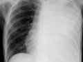 Effusion and Atelectasis-opacified hemithorax with no shift of heart or mediastinal structures. Implies large effusion with underlying obstructive atelectasis, a combination ominous for bronchogenic carcinoma with metastases. 