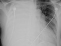 Large Right Pleural Effusion-Shift of heart and mediastinal structures away from side of opacified hemithorax. Large effusion occupies more space. 