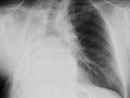 Right Pneumonectomy-Shift towards side of opacifies hemithorax, like atelectasis, but surgical clips and missing rib indicate prior surgery.  