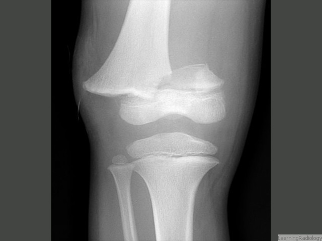 Salter-Harris II. Most common-85%. Involves both the epiphyseal plate and the metaphysis. Small corner of metaphysis produces the 'corner sign.' Rarely produces complications.