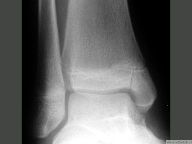 Salter-Harris IV. Involves the epiphyseal plate, metaphysis and epiphysis. Since it, too, involves the epiphysis, the articular cartilage can be damaged. These fractures involve the growing layer of cartilage so growth disturbance can result.