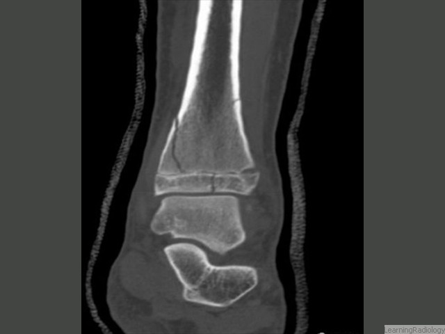 Salter-Harris IV. CT. Involves the epiphyseal plate, metaphysis and epiphysis. 