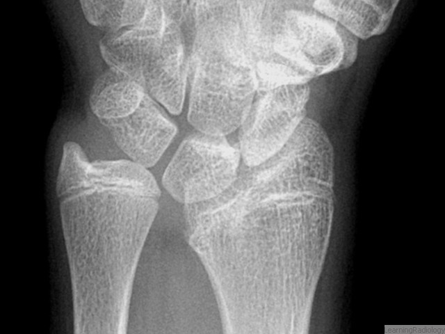 Salter-Harris V. Rare. Compression injury of epiphyseal plate. Initial diagnosis may be difficult; not made until growth disturbance at epiphyseal plate occurs resulting in angular deformities, such as here. Have the worst prognosis of the Salter-Harris fractures.