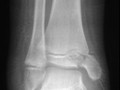 Salter-Harris IV Fracture involving epiphysis, epiphyseal plate and a very small corner of the metaphysis.