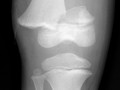 Salter-Harris II. Most common-85%. Involves both the epiphyseal plate and the metaphysis. Small corner of metaphysis produces the ?corner sign.? Rarely produces complications.