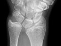 Salter-Harris V. Rare. Compression injury of epiphyseal plate. Initial diagnosis may be difficult; not made until growth disturbance at epiphyseal plate occurs resulting in angular deformities, such as here. Have the worst prognosis of the Salter-Harris fractures.