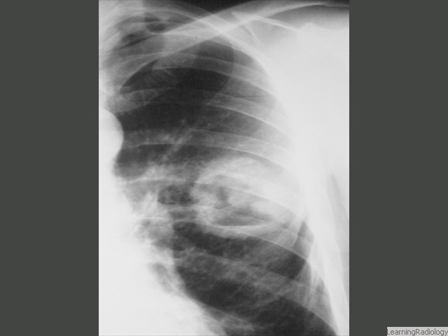 Cavitary Lesions of the Lung