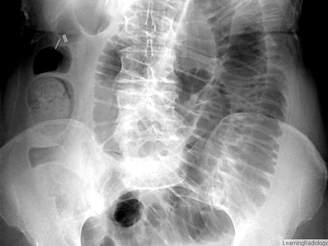 Abnormal Bowel Gas Patterns