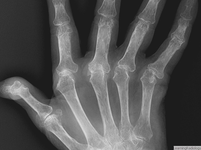 Arthritides-Hands