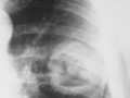 Cavitary Lesions of the Lung