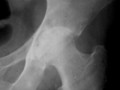 Arthritides-Hip