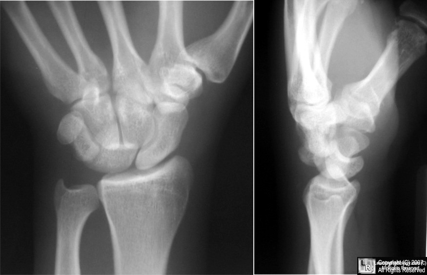 LearningRadiology - Carpal Instabilities