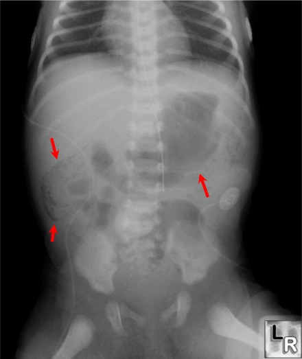 necrotizing enterocolitis