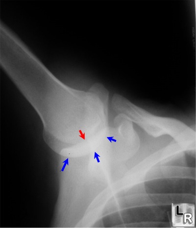 Luxatio Erecta (Inferior Dislocation).