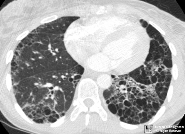 Image result for scleroderma lung