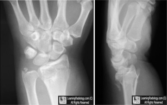 barton vs colles fracture barton vs colles fracture