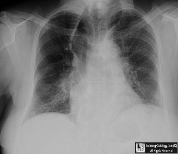 LearningRadiology - achalasia