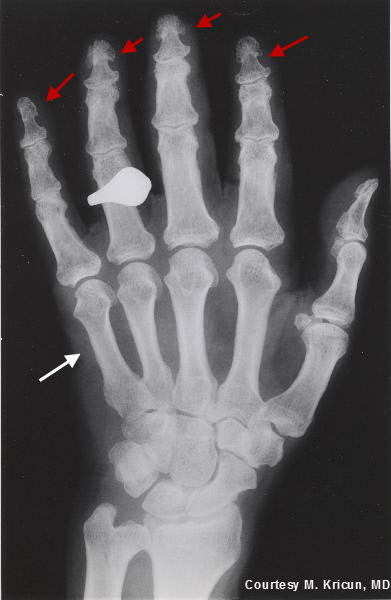 achondroplasia