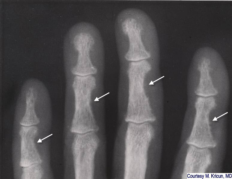 hyperparathyroid