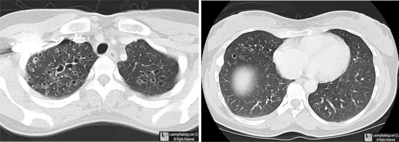Eosinophilic Granuloma of the Lung