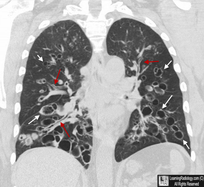 Bronchiectasis X Ray Tram Track