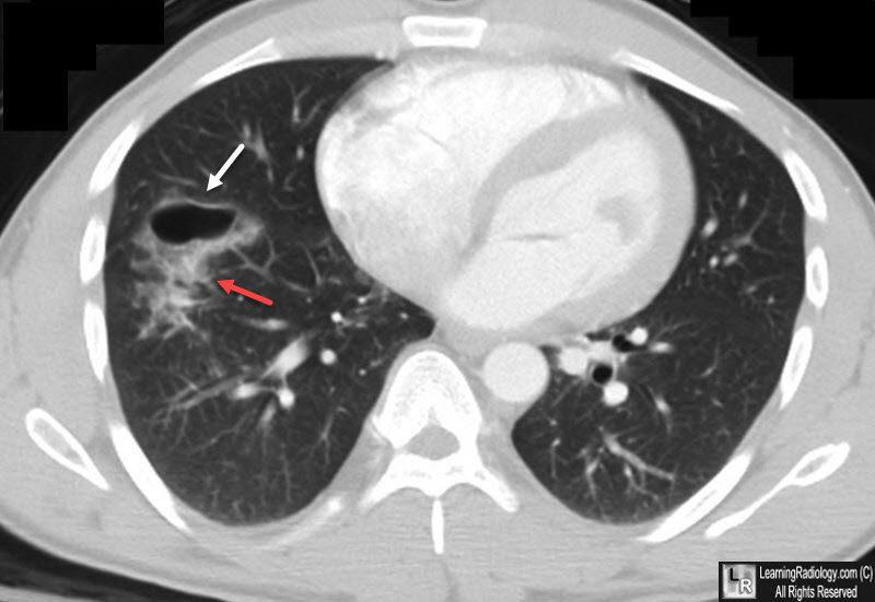 Pulmonary laceration