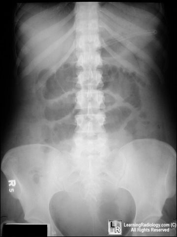 Small bowel obstruction