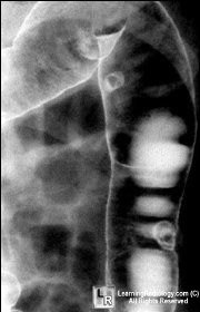 Colonic polyps