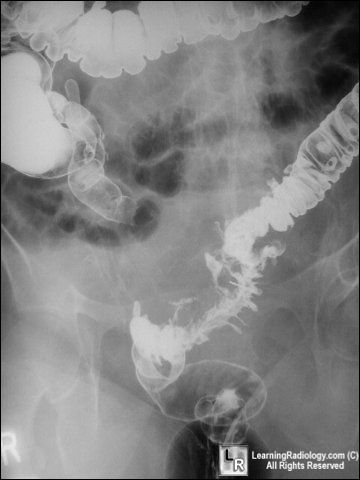 Diverticulitis