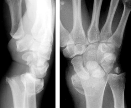 Fractures with Names