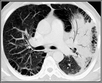 LearningRadiology - Pneumonia