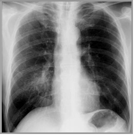 LearningRadiology - Pneumonia