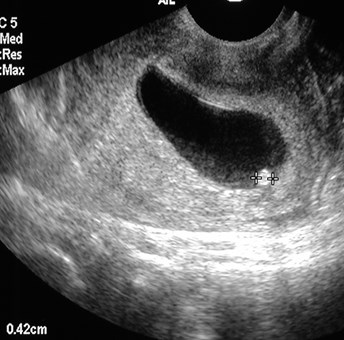 Abnormal First Trimester US-MH