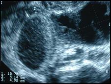Pid Ultrasound Images – Pelvic Inflammatory Disease: Spectrum of ...