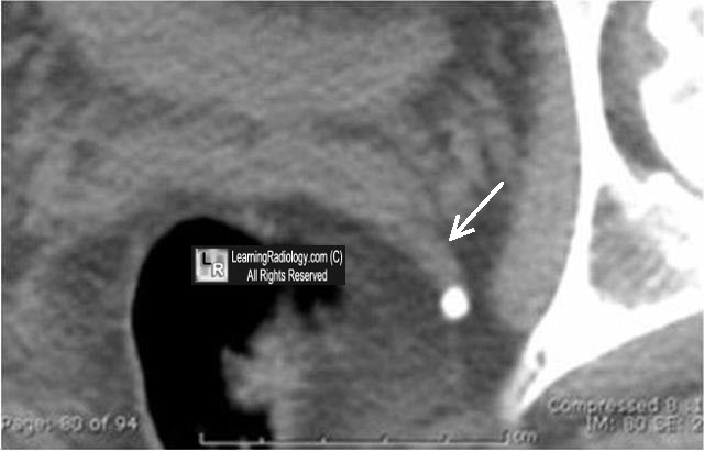 Welcome to LearningRadiology - radiology, radiologic, imaging, signs ...