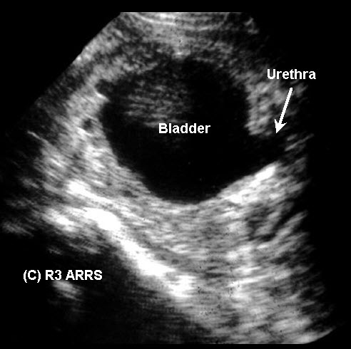 Keyhole Sign Rupture Welcome to LearningRadiology - radiology, radiologic, imaging, sign ...